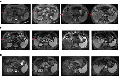 Recurrent Gallbladder Carcinoma With pMMR/MSS Achieved a Complete Response Following Camrelizumab Combined With Apatinib: A Case Report